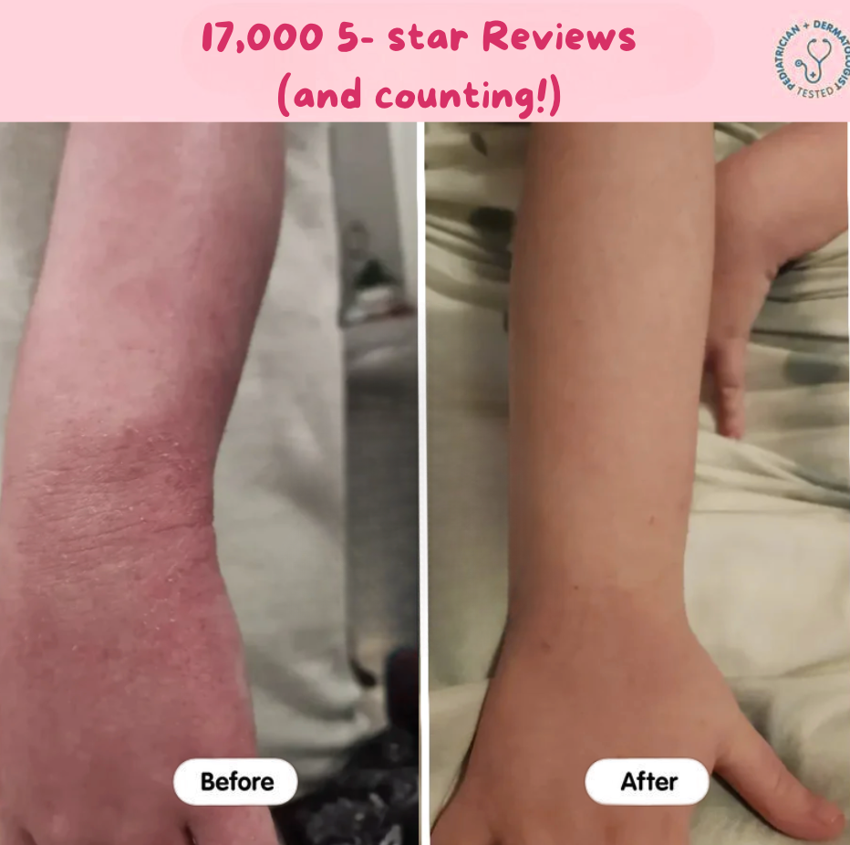 Eczema Beef Tallow Balm -