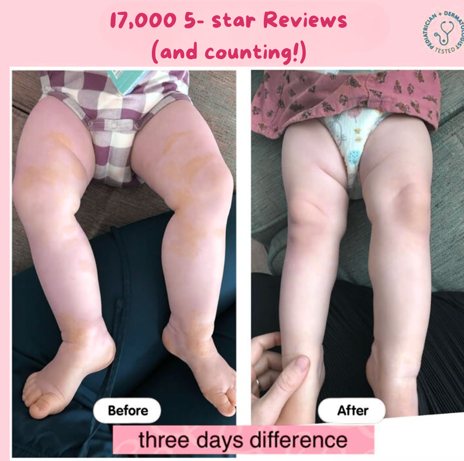 Eczema Beef Tallow Balm -